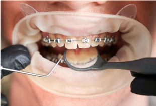 Снятие брекетов