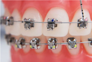 Безлигатурные брекеты