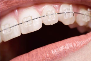Керамические брекеты