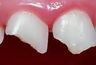 Лечение травм зубов у детей