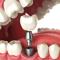 Мифы о зубных имплантах